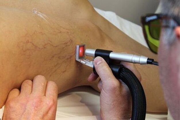 Laser treatment of varicose veins on the lower leg