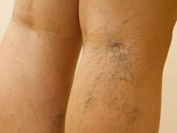 varicose veins below the knee