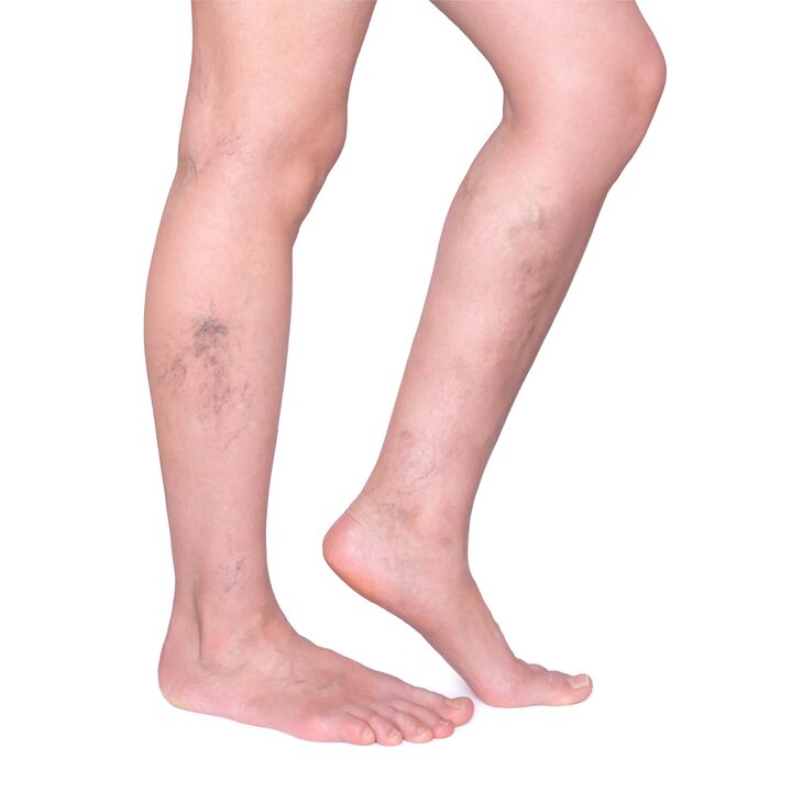 indications for Neoveris - swollen, winding veins in the legs